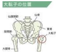 大転子が出っ張っているのと 骨盤が歪んでるのは違う意味ですか Yahoo 知恵袋