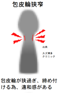 包皮輪狭窄で通常時は強引になんとか剥ける状態でも 保険適応に Yahoo 知恵袋