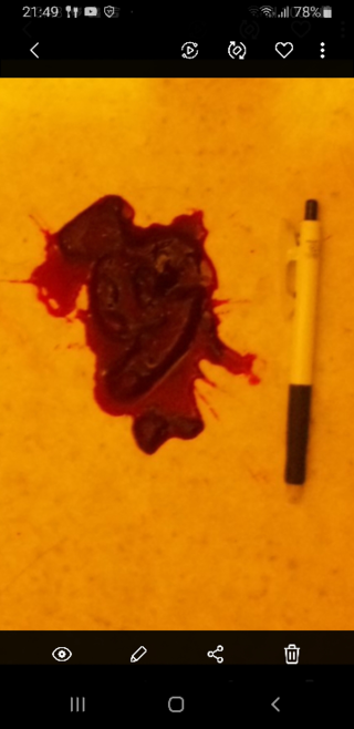 新しいコレクション 生理血の塊レバー画像 55
