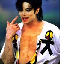 マイケル ジャクソンの肌が白くなったのは皮膚移植したからですか Yahoo 知恵袋