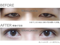 二重切開手術を数年前に行っているのですが 重度の眼瞼下垂になってきました 順 Yahoo 知恵袋