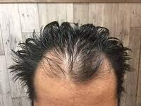 これはm字はげですか 高2男子です 中学の頃に自分の生え際を意識し Yahoo 知恵袋