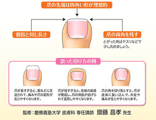 子供の足なんですが 水虫か巻き爪なのかよく分からなくて病院は Yahoo 知恵袋