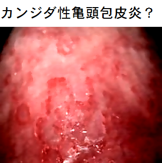 亀頭を見たら絶対に 正常では無い状況になってたのですが痛くも痒く Yahoo 知恵袋