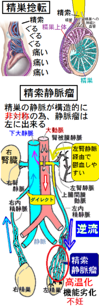 金玉 違和感 ストレス 精索静脈瘤の症状 睾丸 金玉の不快感 痛み しこり コブ 腫れ Tmh Io