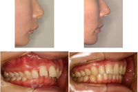 非抜歯矯正って出っ歯が治らず ゴリラ顔になるという最悪なことしかないんですか Yahoo 知恵袋