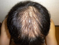 ヘアマックスって効果あるんですか 髪の毛増えた方いますか 薄毛aga Yahoo 知恵袋