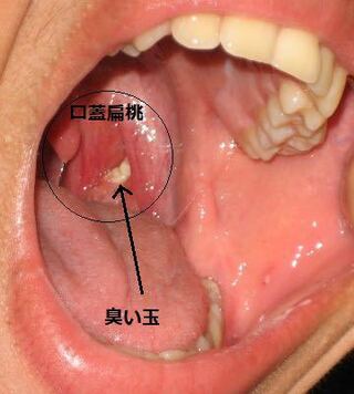 扁桃腺 臭い玉 画像 186112 扁桃腺 臭い玉 画像