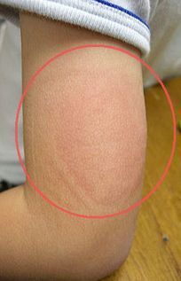 インフルエンザの予防接種後 直径10cm位の範囲で赤く腫れて痛いです 大人で Yahoo 知恵袋