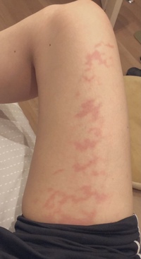 電気毛布を使う様になったからなのかはわかりませんが足があちこち痒くて画像の Yahoo 知恵袋