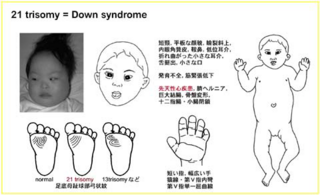 ダウン症の足裏の指紋はじめましてこんばんは 今年出産した娘がダウン Yahoo 知恵袋