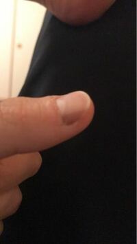 数ヶ月前から4歳の子供の爪に黒い線があるのに気づきました 黒い線 癌 Yahoo 知恵袋