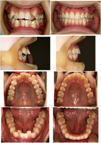 歯の矯正について 抜歯は何本しましたか 親知らずも抜いた場合は含めた数で教えて Yahoo 知恵袋