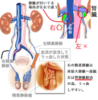 中学生の頃から精索静脈瘤 のようになっているんですが不妊症になります Yahoo 知恵袋