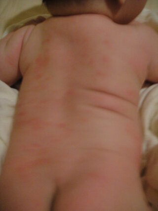 祖母 透ける 上記の頭と肩 赤ちゃん お腹 に 赤い 湿疹 Opt54 Jp