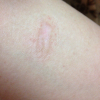 彼女がヘアーアイロン でやけどしてしまって 大きい水ぶくれができて割れ Yahoo 知恵袋