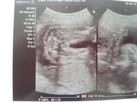 24ｗ妊婦です このエコー写真で性別がわかりますか 足 Yahoo 知恵袋