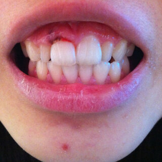 前歯の歯茎が腫れていたので歯医者に行くと 歯肉炎や歯槽膿漏で腫れてるの Yahoo 知恵袋