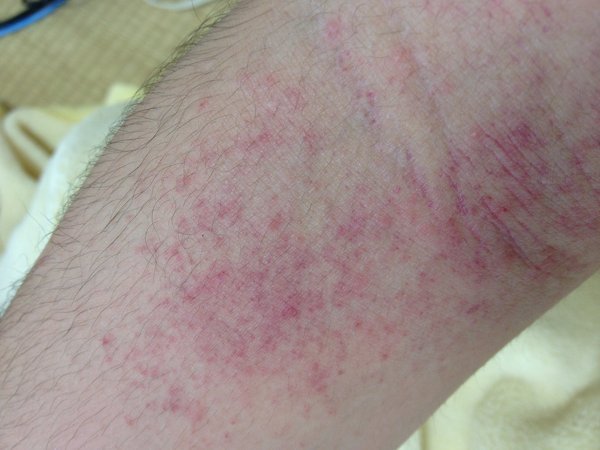アトピーでしょうか 画像あり ここ数日 首と肘の裏が炎症を起こ Yahoo 知恵袋
