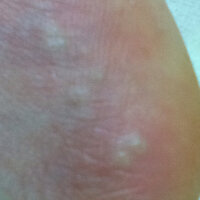 足にブツブツができました 中に水 が溜まっているみたいです 画像の Yahoo 知恵袋