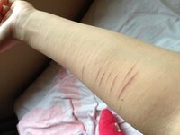 リストカットの傷痕と仕事 画像あります 閲覧注意 わた Yahoo 知恵袋