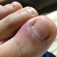 足の親指が痛いです 爪の横の部分が腫れていて さっき腫れてい Yahoo 知恵袋
