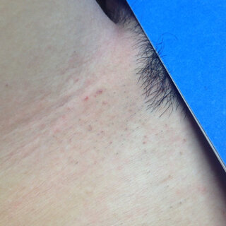 ピンセットで毛抜きをした後 黒い点々がたくさん残ってしまいま Yahoo 知恵袋