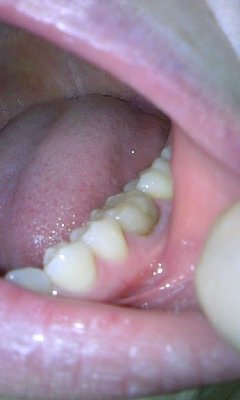これは虫歯ですか 歯と歯茎の境が黒ずんできています 虫歯だと Yahoo 知恵袋