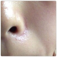 鼻の周りにこのようなブツブツができていて悩んでいます どうす Yahoo 知恵袋