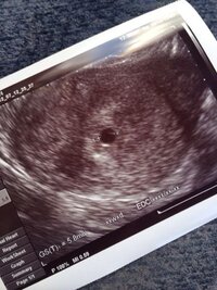 妊娠6週目胎嚢が小さい こんばんは不安なので 教えて下さい 病院に行っ Yahoo 知恵袋