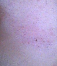 中3女子です 鼻とほっぺたの黒いブツブツに困っています これは角栓なの Yahoo 知恵袋