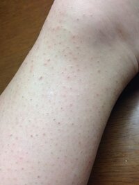 埋没毛治し方高1女です 二年間ほど埋没毛をほじくって抜く癖がぬけなくて やり Yahoo 知恵袋