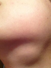 首の おそらく リンパ腺が腫れています 結構痛いです Yahoo 知恵袋