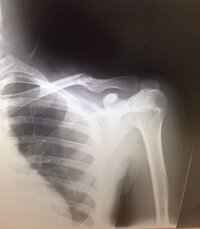 16歳男鎖骨骨折 これが事故当日あと2日で二週間バンド固 Yahoo 知恵袋