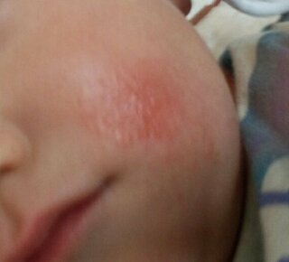 生後7ヶ月のよだれかぶれと首の湿疹治らなくて困ってます Yahoo 知恵袋