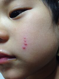 子供の顔に出来た湿疹かおできについて 現在4歳になる息子なん Yahoo 知恵袋