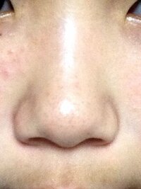 ひどい写真ですいません 団子鼻を自力で治すことはできますか Yahoo 知恵袋