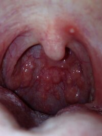 奥 痛い の 喉 が 喉の上が痛い！この症状の原因や病名は？