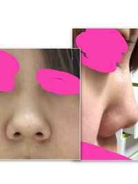 画像あり注意 鼻が低い 豚鼻で悩んでます 凄いコンプレック Yahoo 知恵袋
