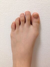 2歳の子供の足の人差し指が中指より短いです 両足です 先天性の病 Yahoo 知恵袋