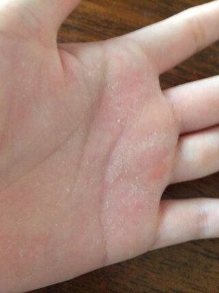 むける 皮 手のひら の