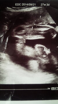 エコー写真をみて性別わかる方いらっしゃいますか 今双子を妊娠 Yahoo 知恵袋