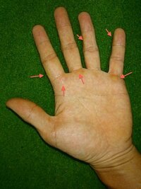 ゴルフで出来るタコについて教えて下さい 右手薬指第一関節の小指側部分 Yahoo 知恵袋