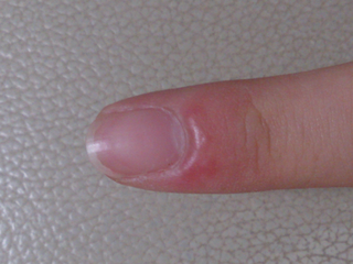 右手人差し指の爪の根元が腫れてしまいました これはなにかの病気な Yahoo 知恵袋