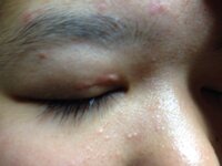 子供の怪我 縫う基準は何ですか 縫うべきなのか 様子見てても Yahoo 知恵袋