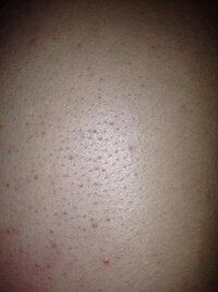 背中になんか触るの鳥肌みたいにザラザラしたものがあります これはなんで Yahoo 知恵袋