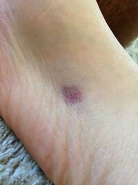 数日前から足の裏に紫色のあざがあります これは皮膚ガン等の危険な Yahoo 知恵袋