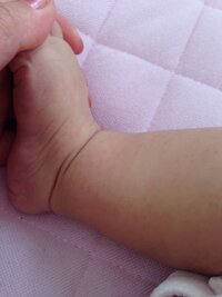 5ヶ月の赤ちゃんです 2 3日前から スネから下 肘か Yahoo 知恵袋