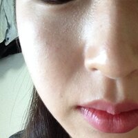 白い ぶつぶつ 目の下