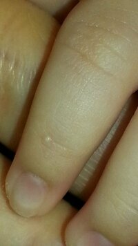 1才半の子供の爪のことなんですが 人差し指の爪に白いできものがあるのです Yahoo 知恵袋
